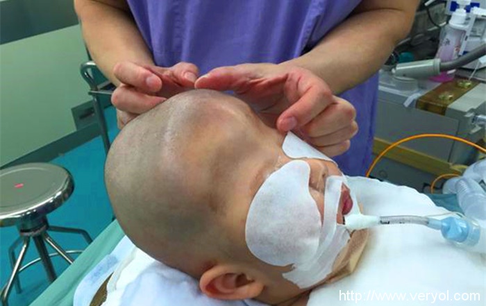 小孩患上狹顱癥 醫生借助3D打印建模為其“補顱”成功(圖1) i