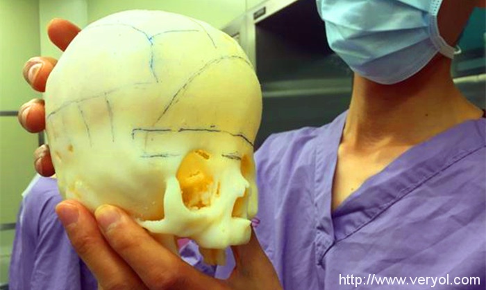 小孩患上狹顱癥 醫生借助3D打印建模為其“補顱”成功(圖2) k